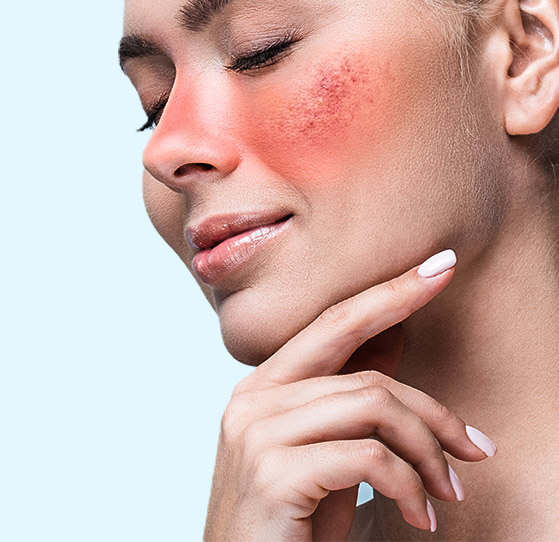 finacea cream for rosacea